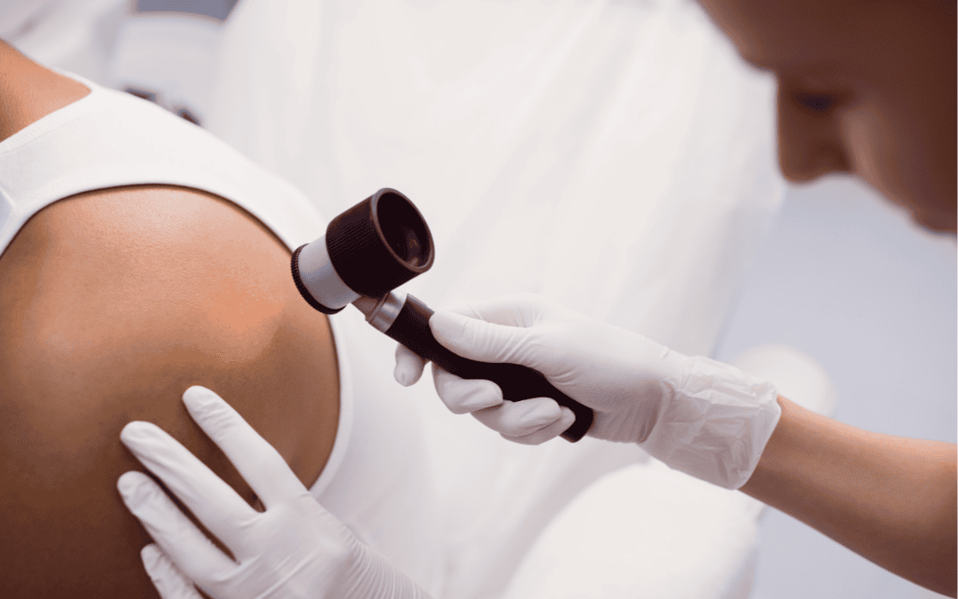 when should a mole be removed